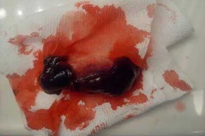 چه خونریزی در بارداری خطرناک است